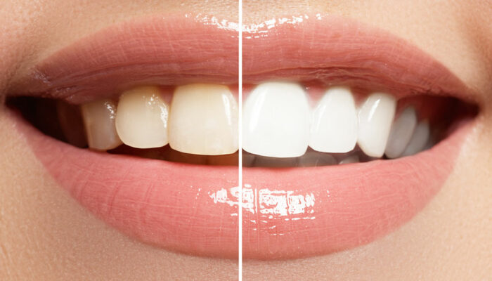 5 reasons at-home teeth whitening isn’t ideal always