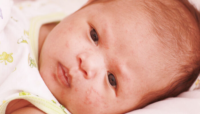 Atopic dermatitis in infants – Signs and management tips