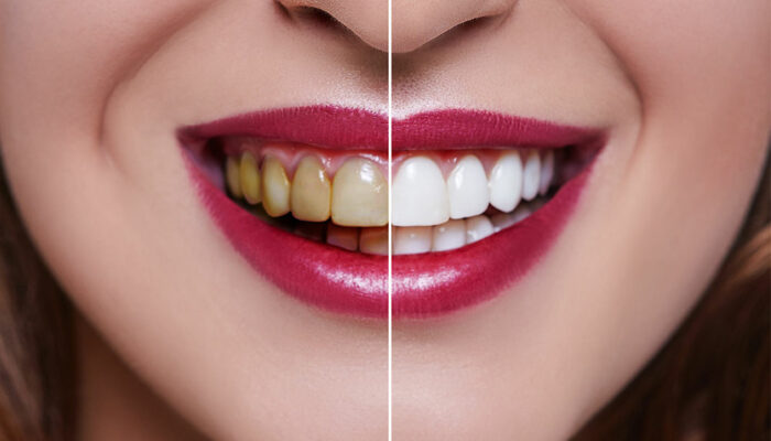 Dental veneers’ cost, procedure, and results