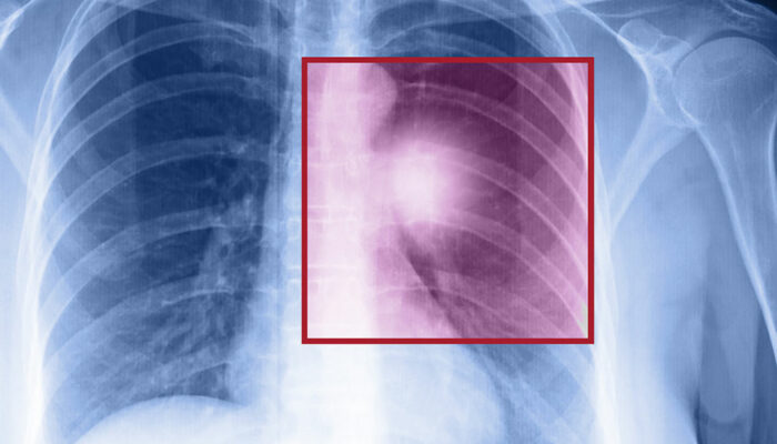 Lung cancer – Types, symptoms, and causes